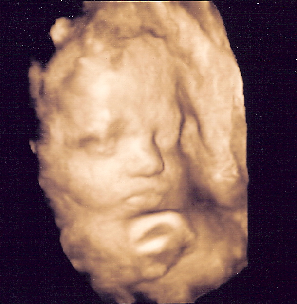 3d ultrasound pictures at 26 weeks. 3d ultrasound pictures of